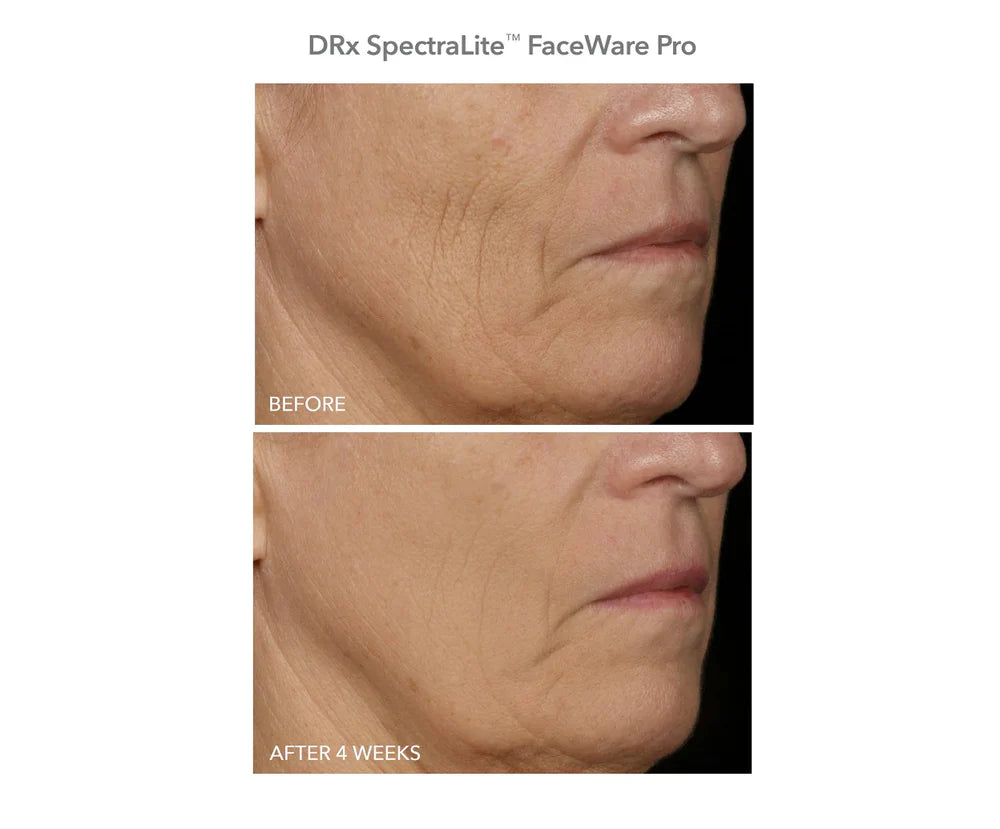 DRx SpectraLite FaceWare PRO